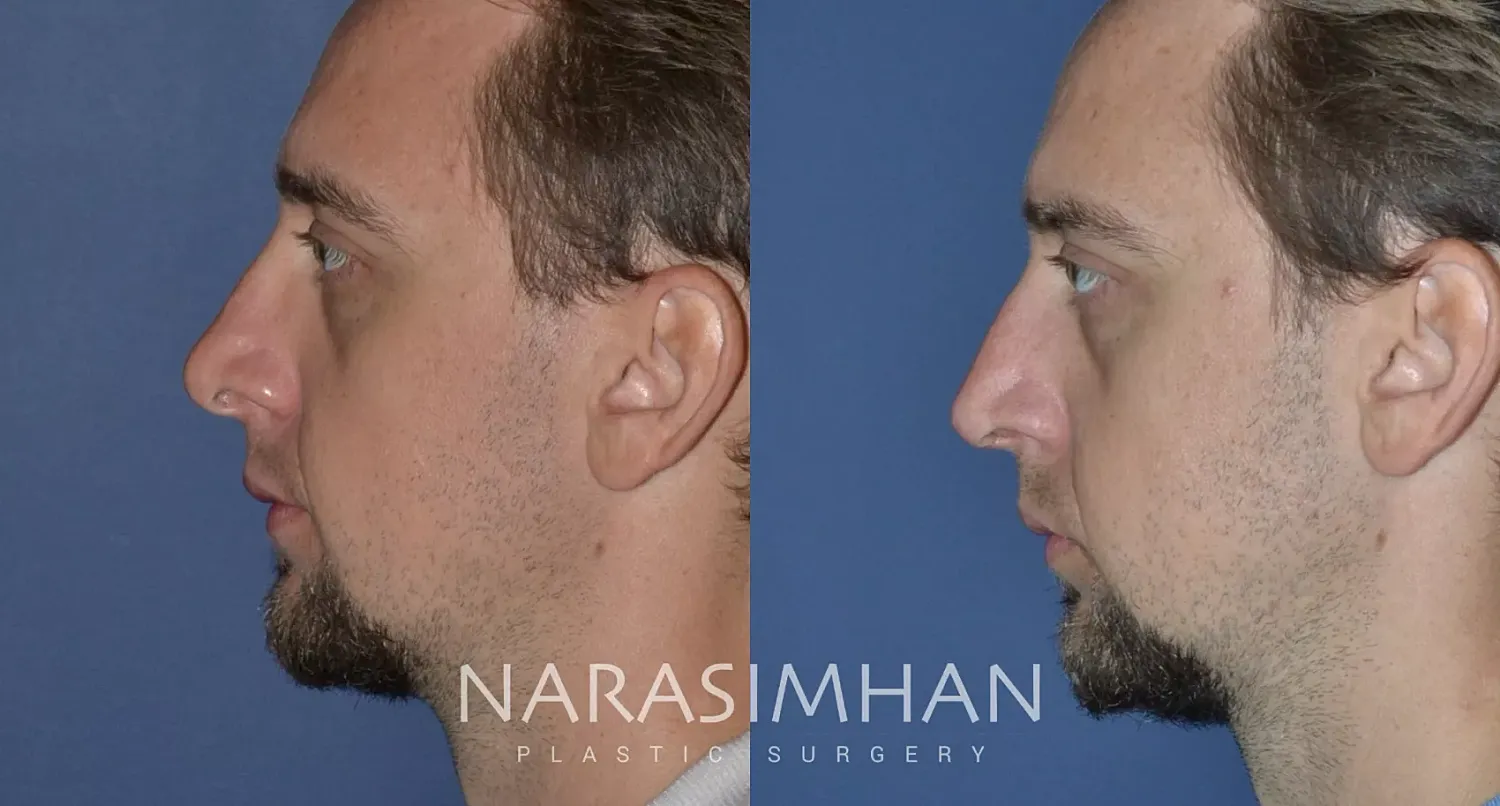 Revision Rhinoplasty Before & After