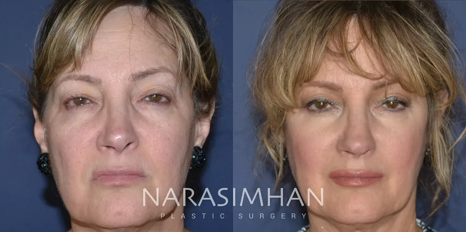 Revision Rhinoplasty Before & After