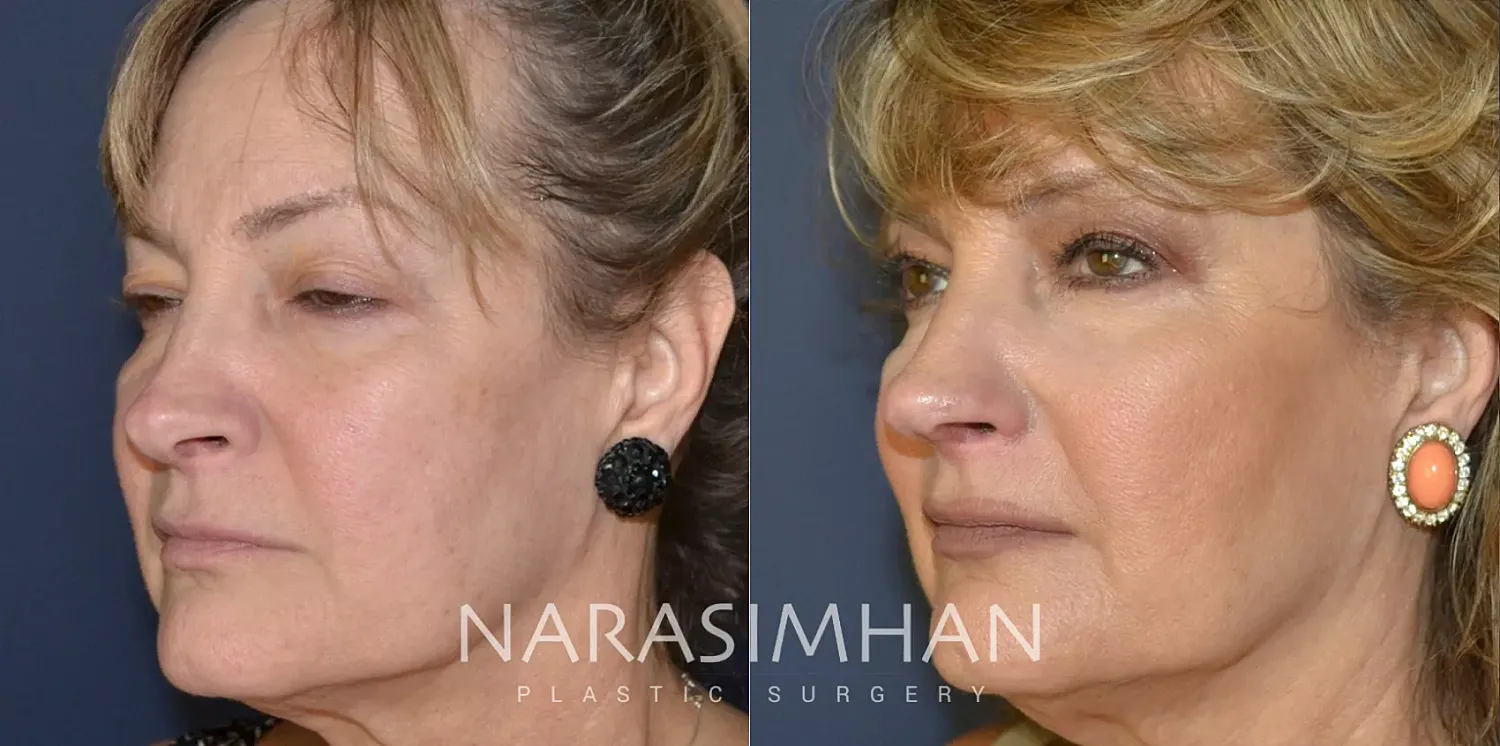 Revision Rhinoplasty Before & After