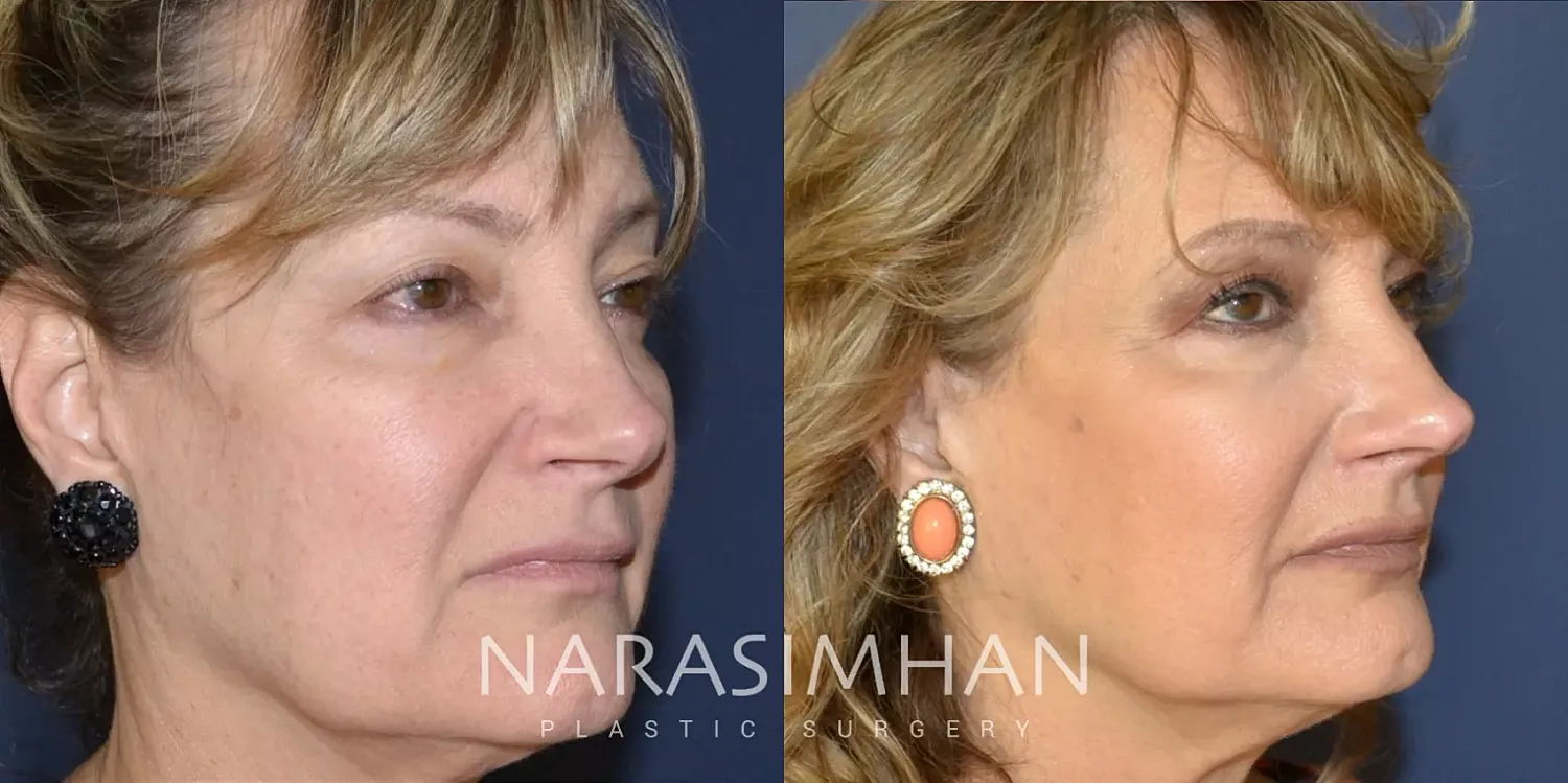 Revision Rhinoplasty Before & After