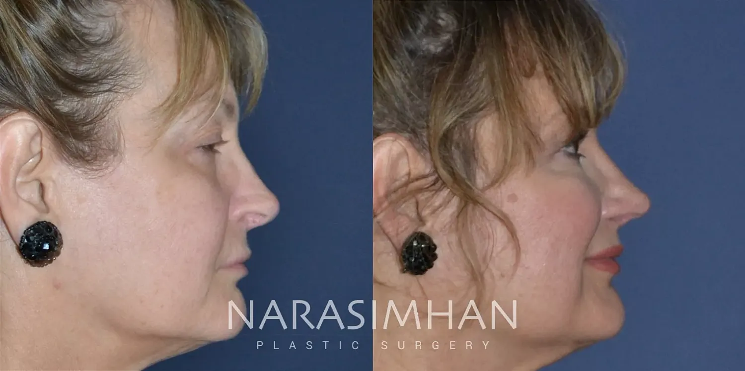 Revision Rhinoplasty Before & After