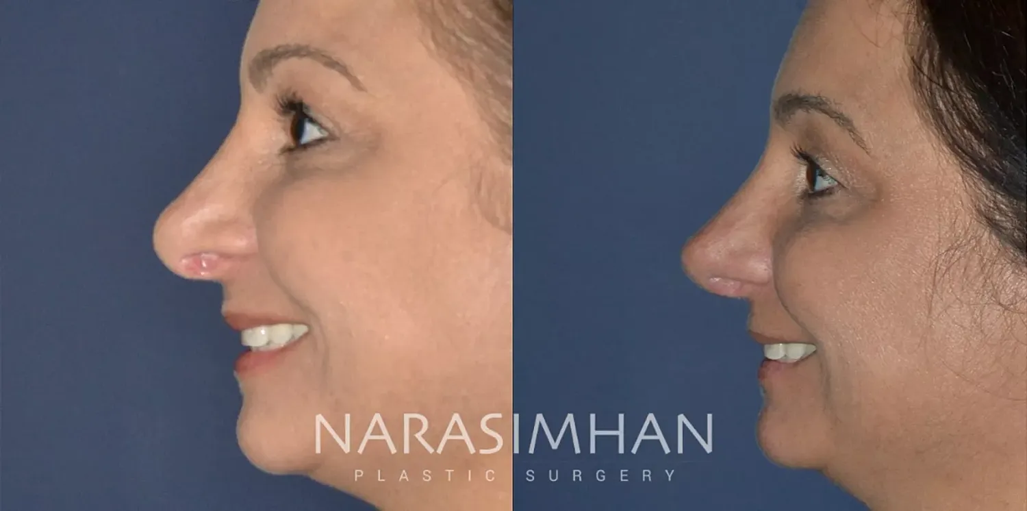 Revision Rhinoplasty Before & After