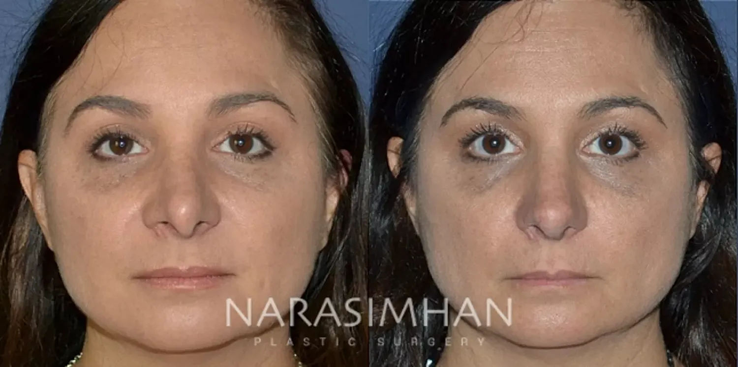 Revision Rhinoplasty Before & After