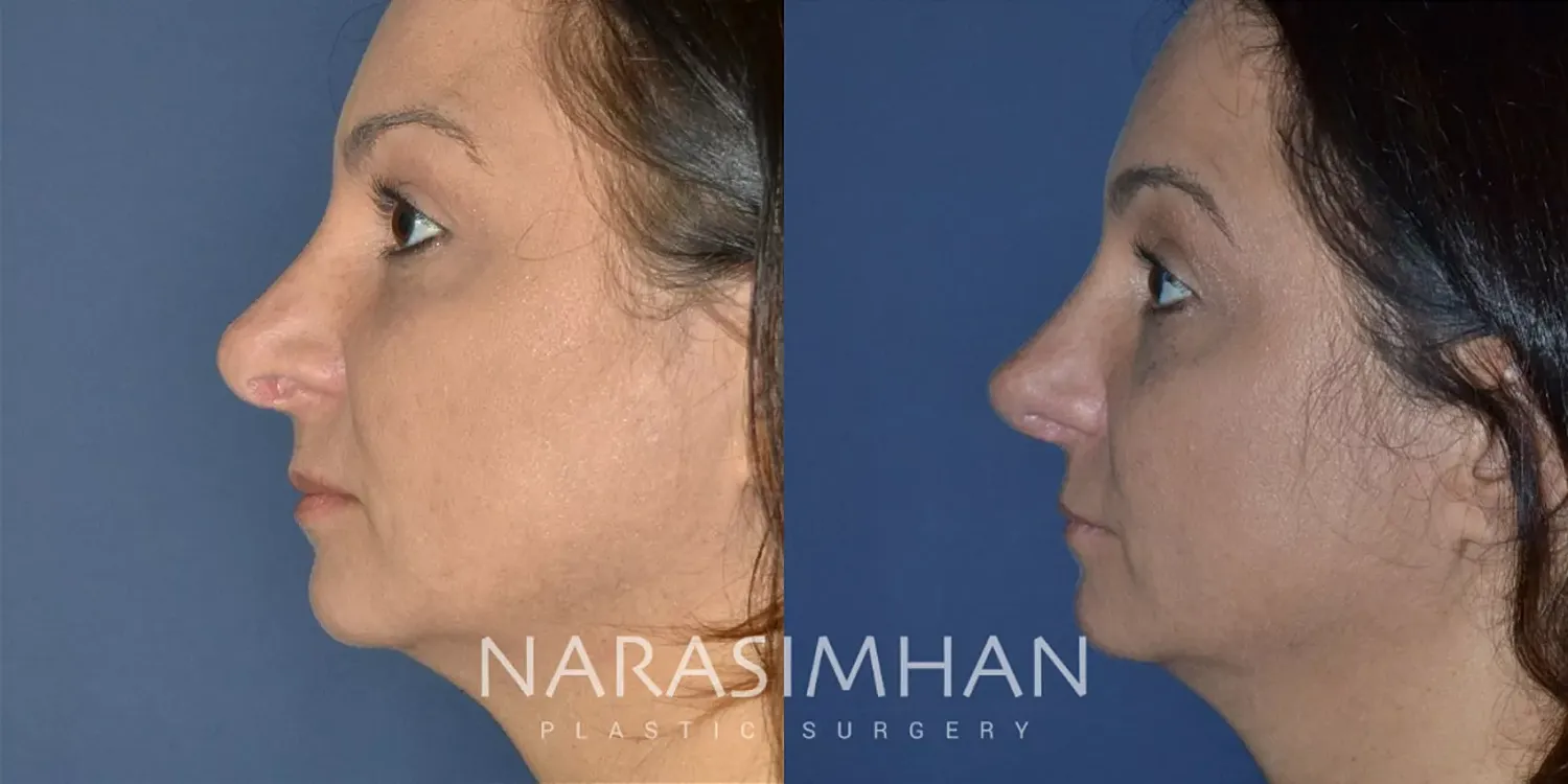 Revision Rhinoplasty Before & After