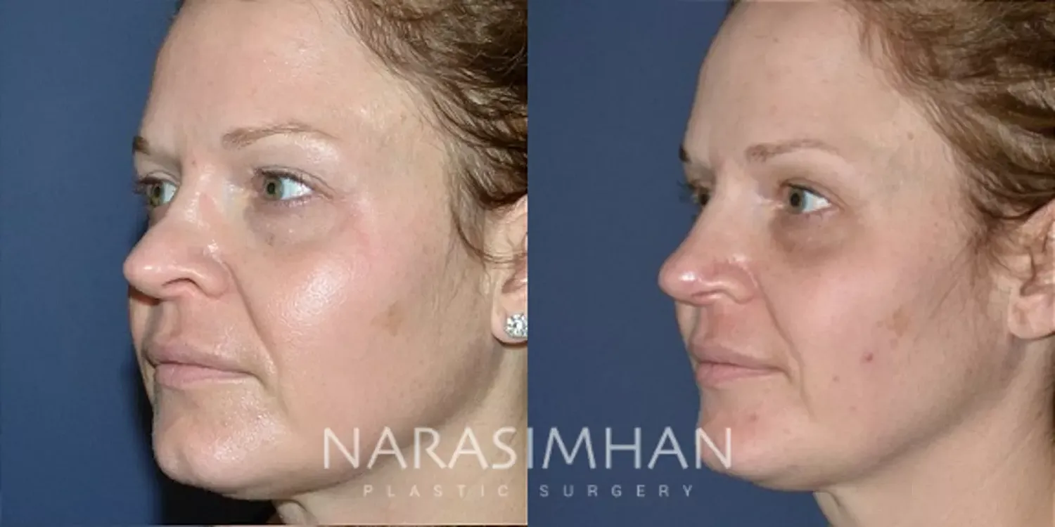 Revision Rhinoplasty Before & After