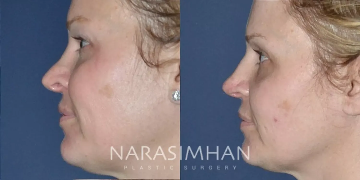 Revision Rhinoplasty Before & After