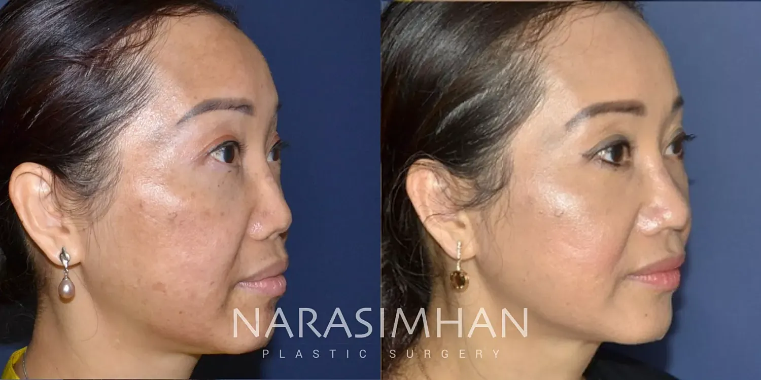 Revision Rhinoplasty Before & After