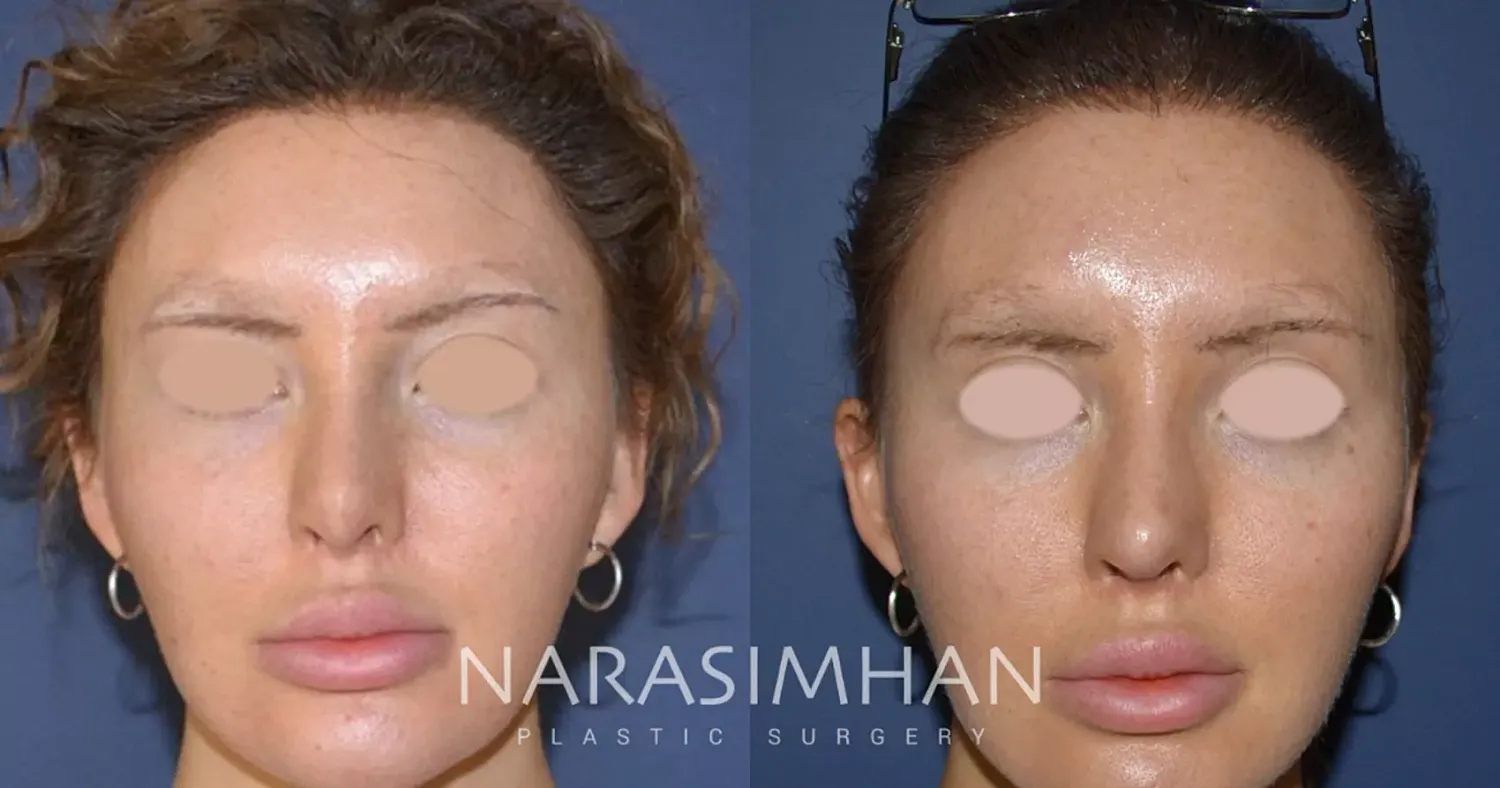 Revision Rhinoplasty Before & After