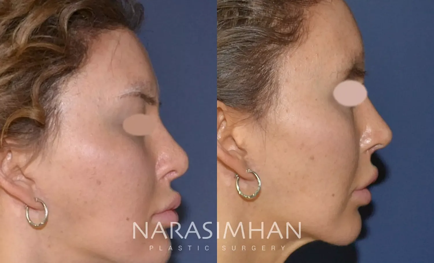 Revision Rhinoplasty Before & After