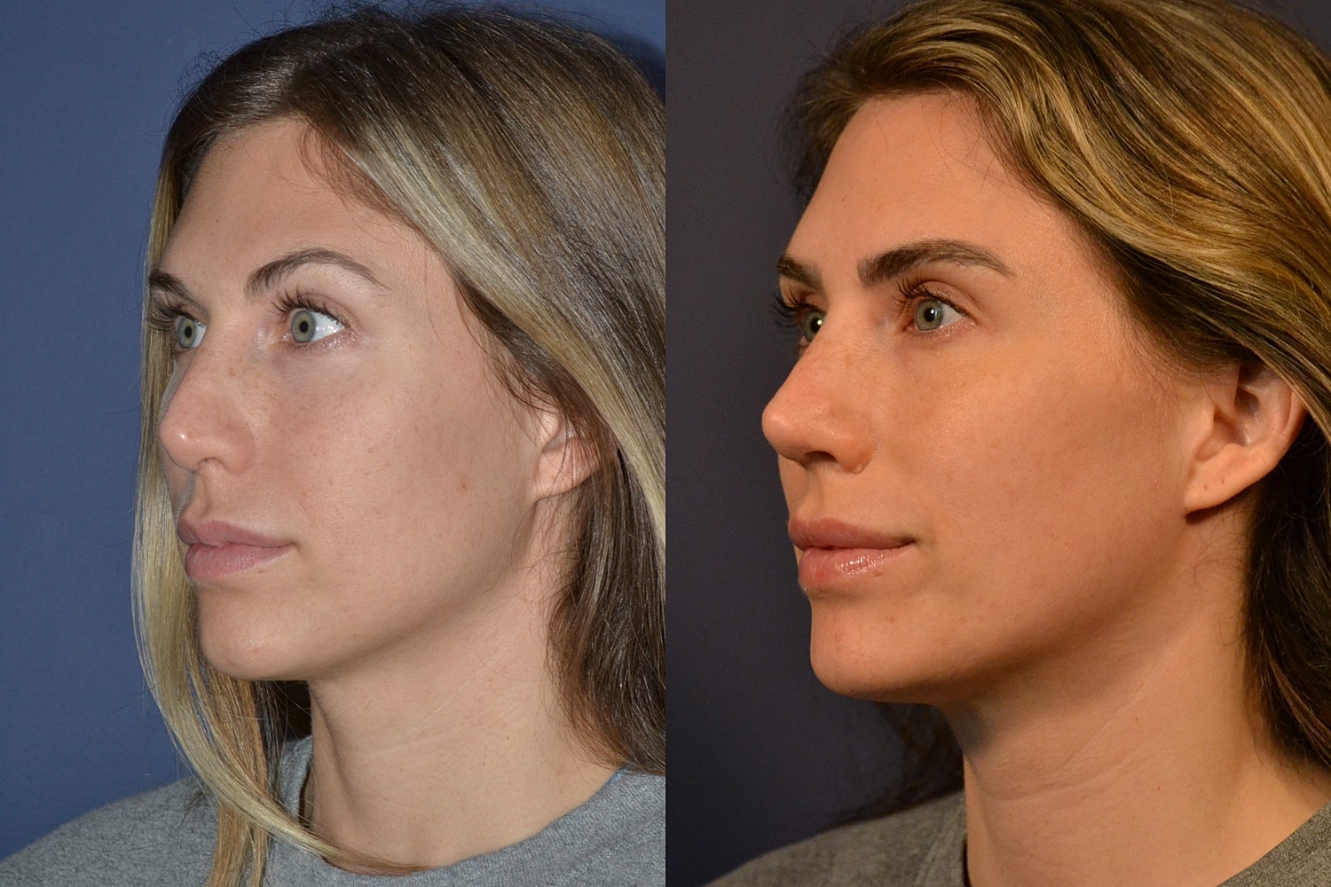 Revision Rhinoplasty Before & After