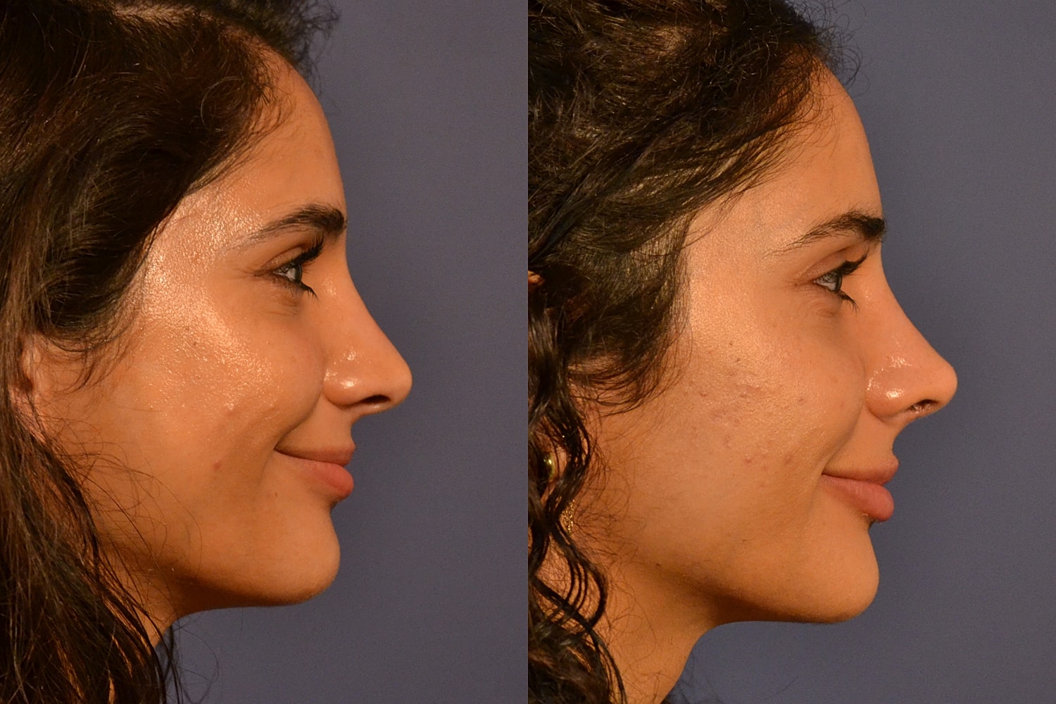 Revision Rhinoplasty Before & After