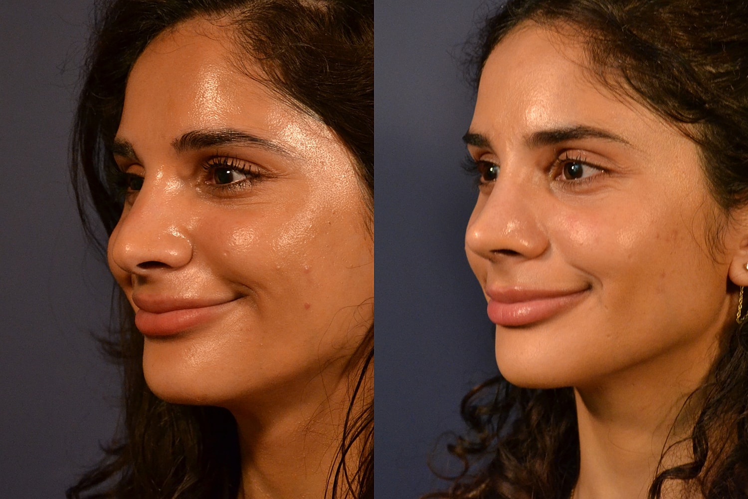 Revision Rhinoplasty Before & After