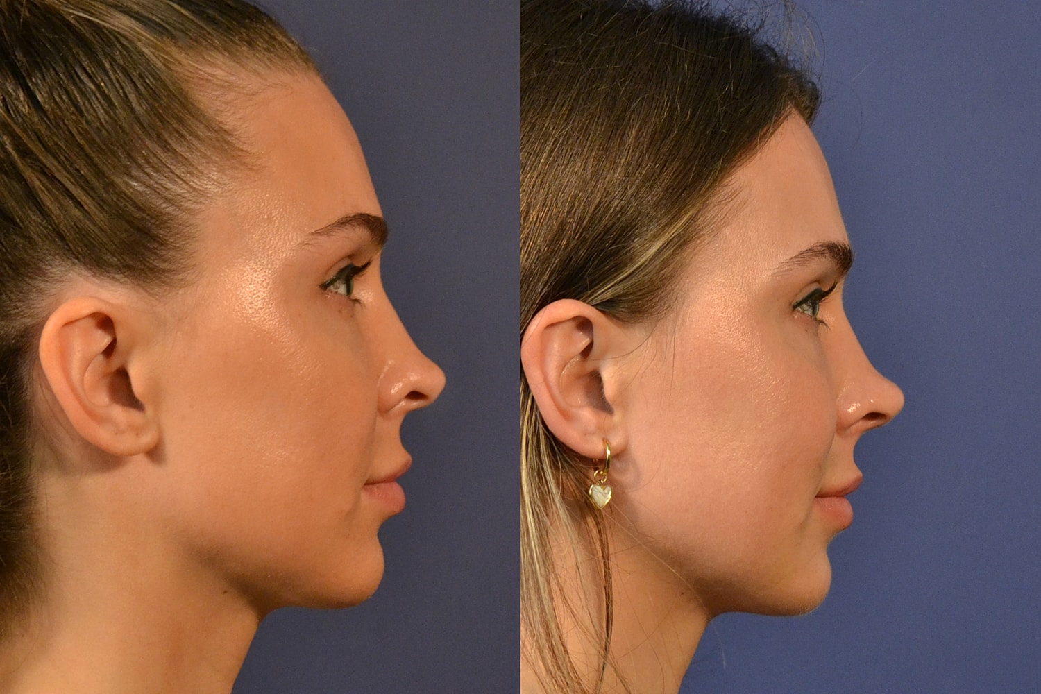 Revision Rhinoplasty Before & After