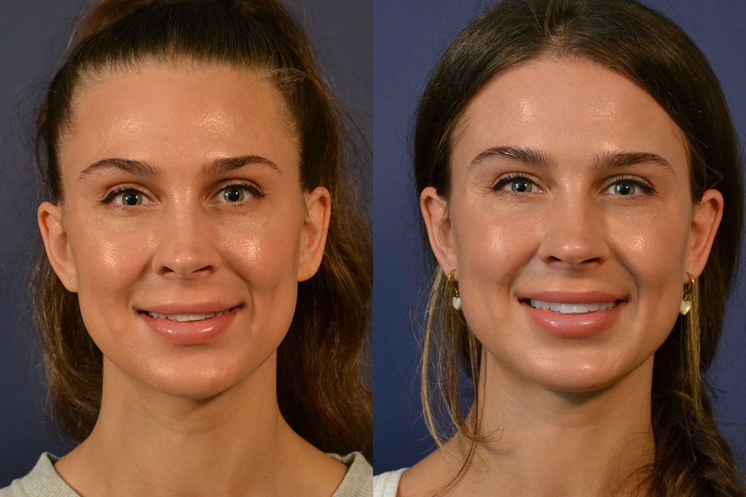 Revision Rhinoplasty Before & After