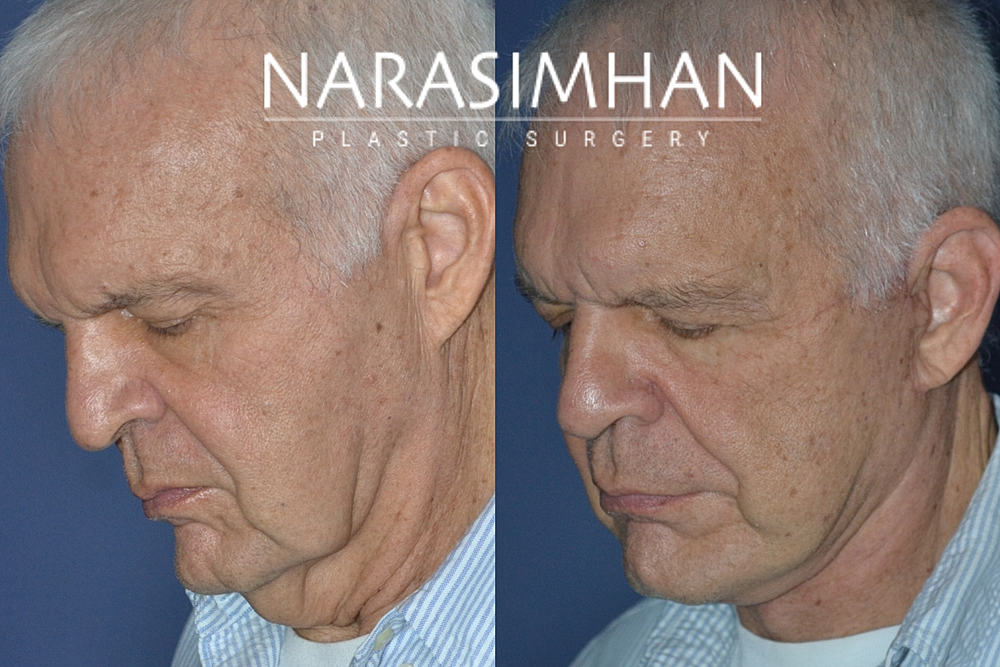 Neck Lift Before & After