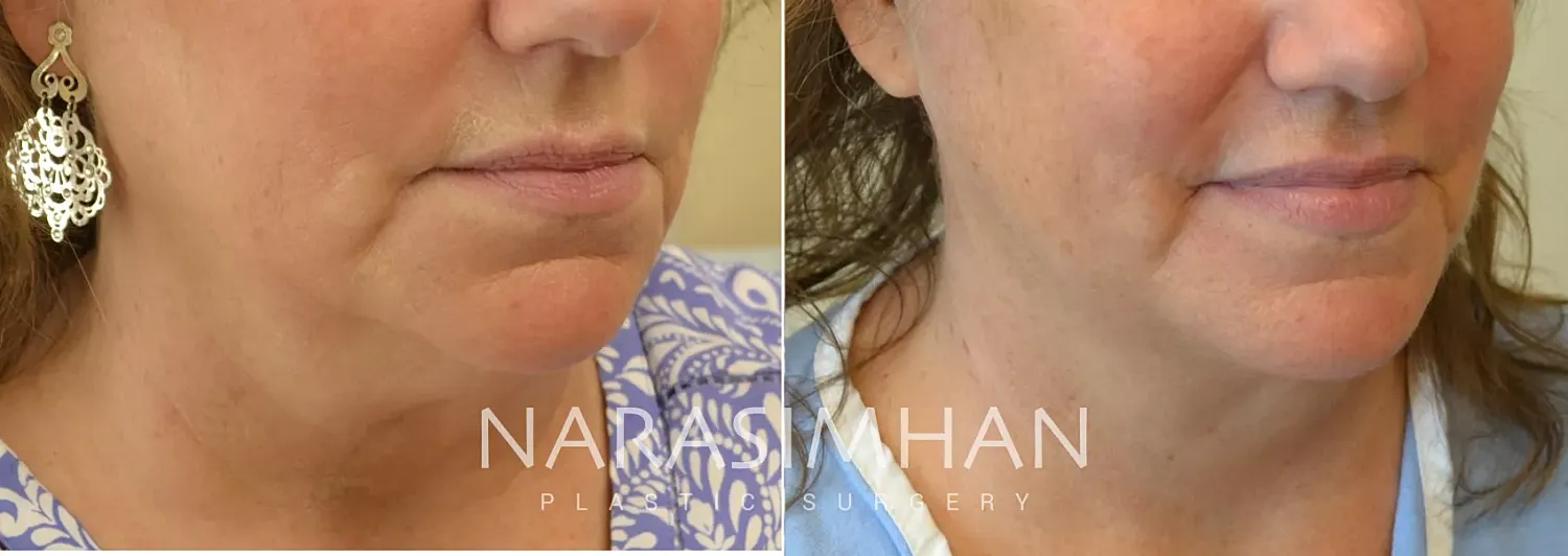 Neck Lift Before & After
