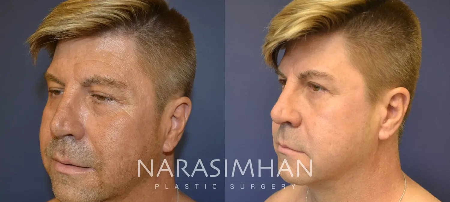 Neck Lift Before & After