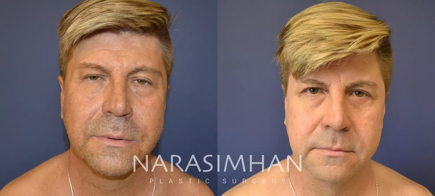 Neck Lift Before & After