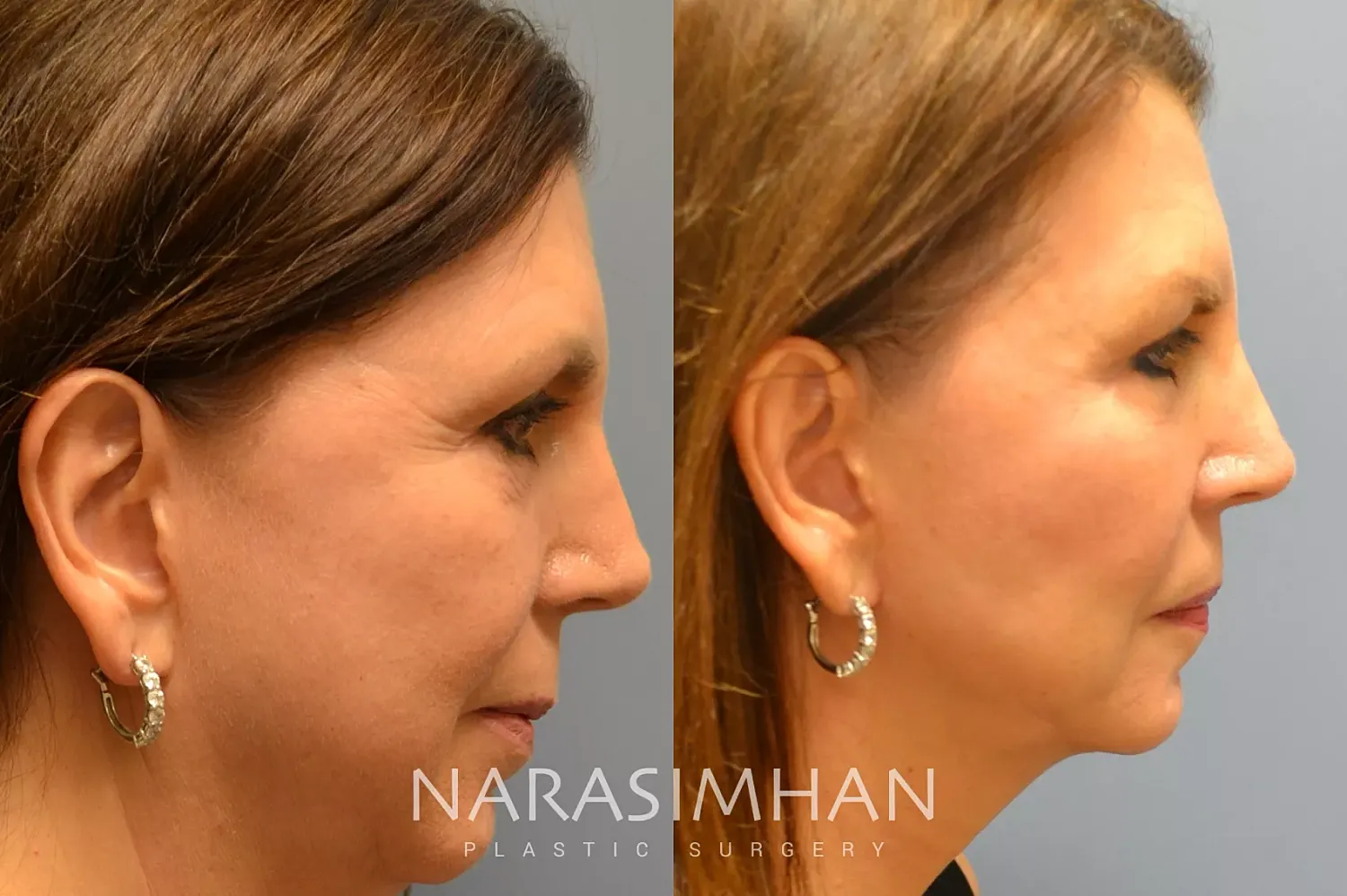 Neck Lift Before & After