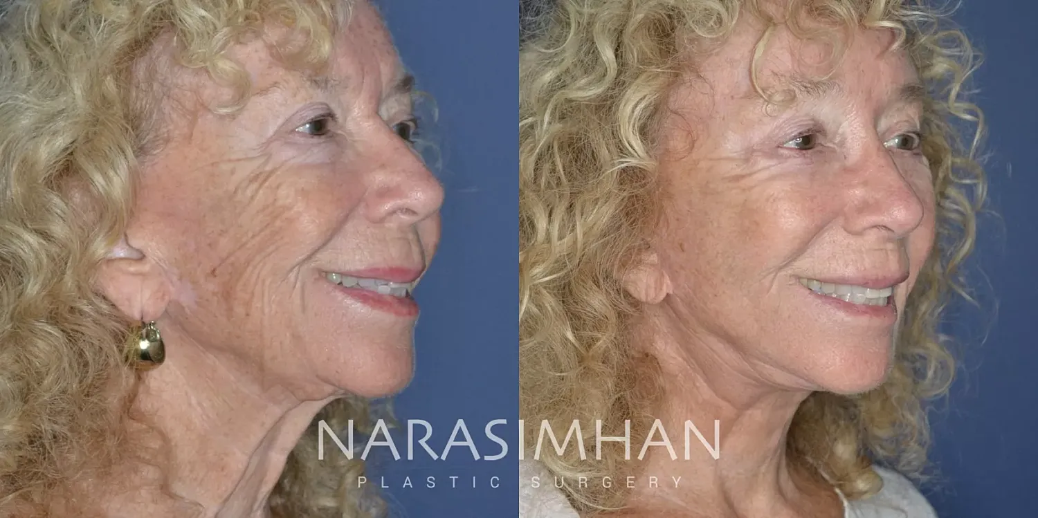 Neck Lift Before & After