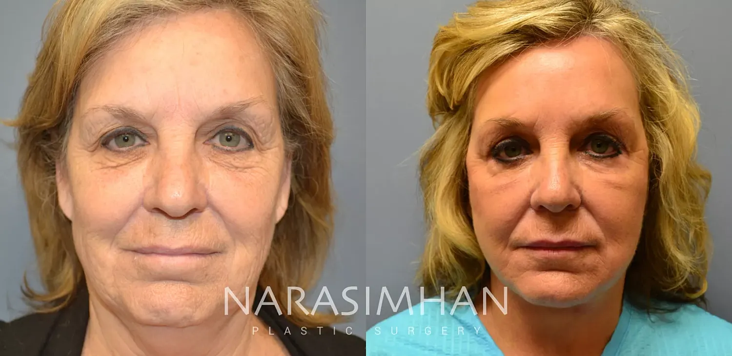 Neck Lift Before & After