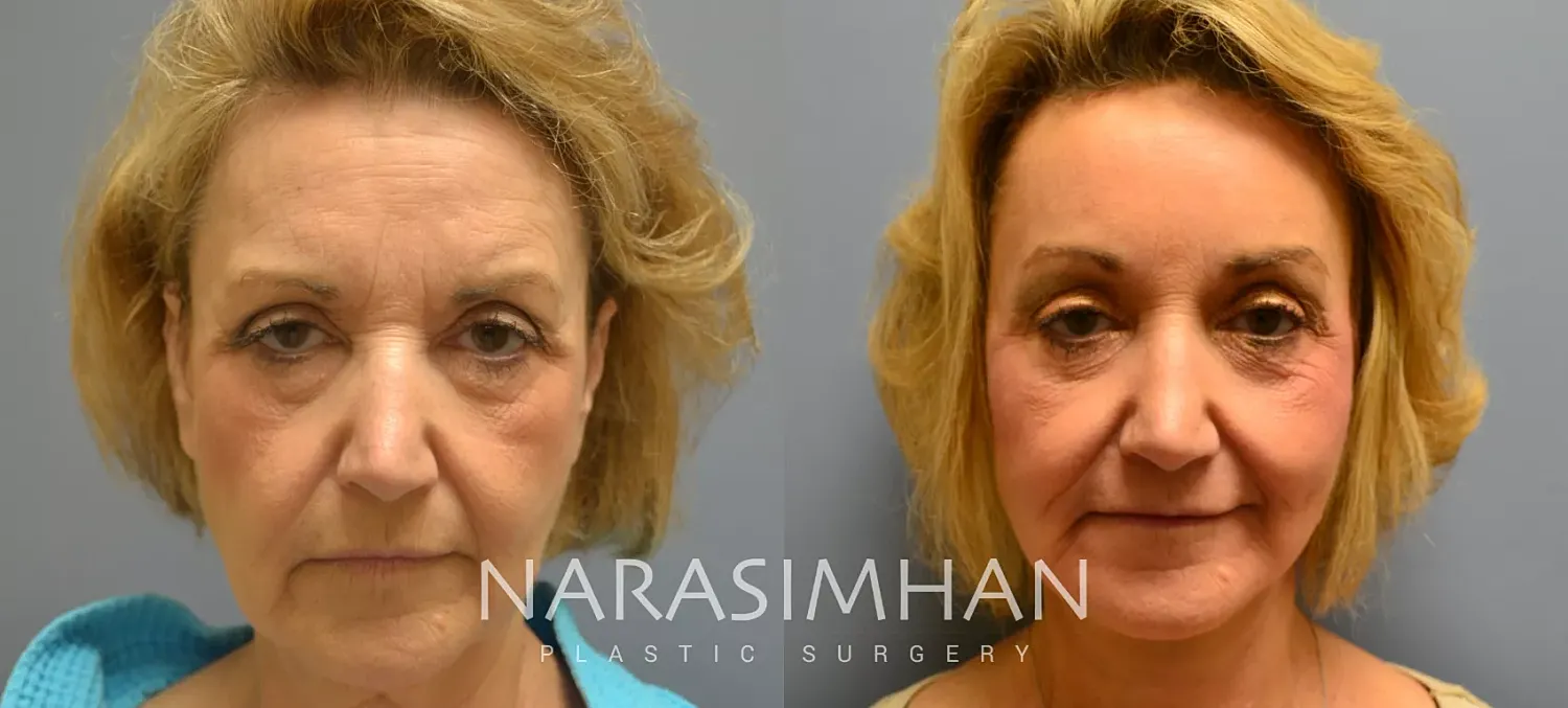 Neck Lift Before & After