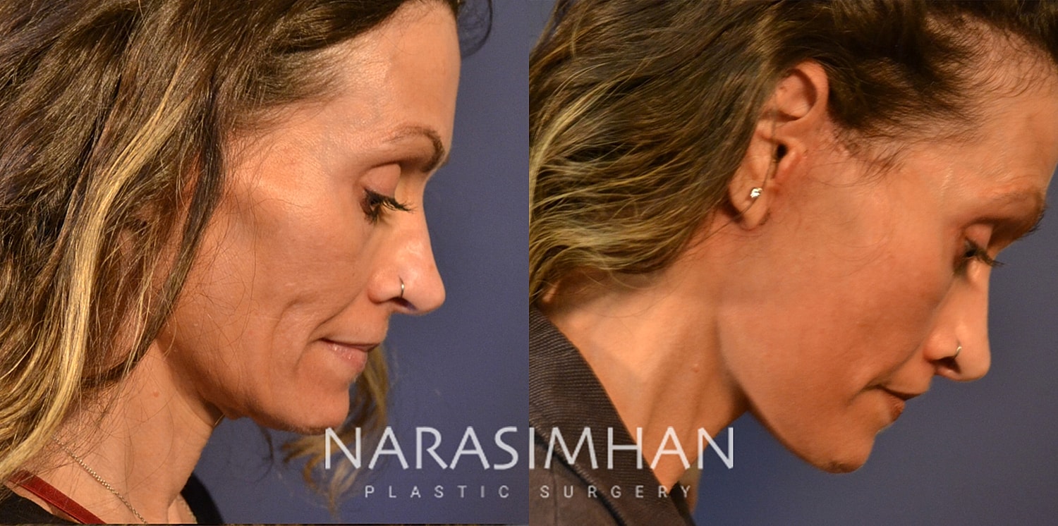 Neck Lift Before & After