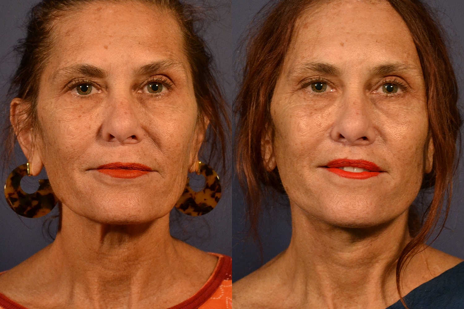 Facelift Before & After