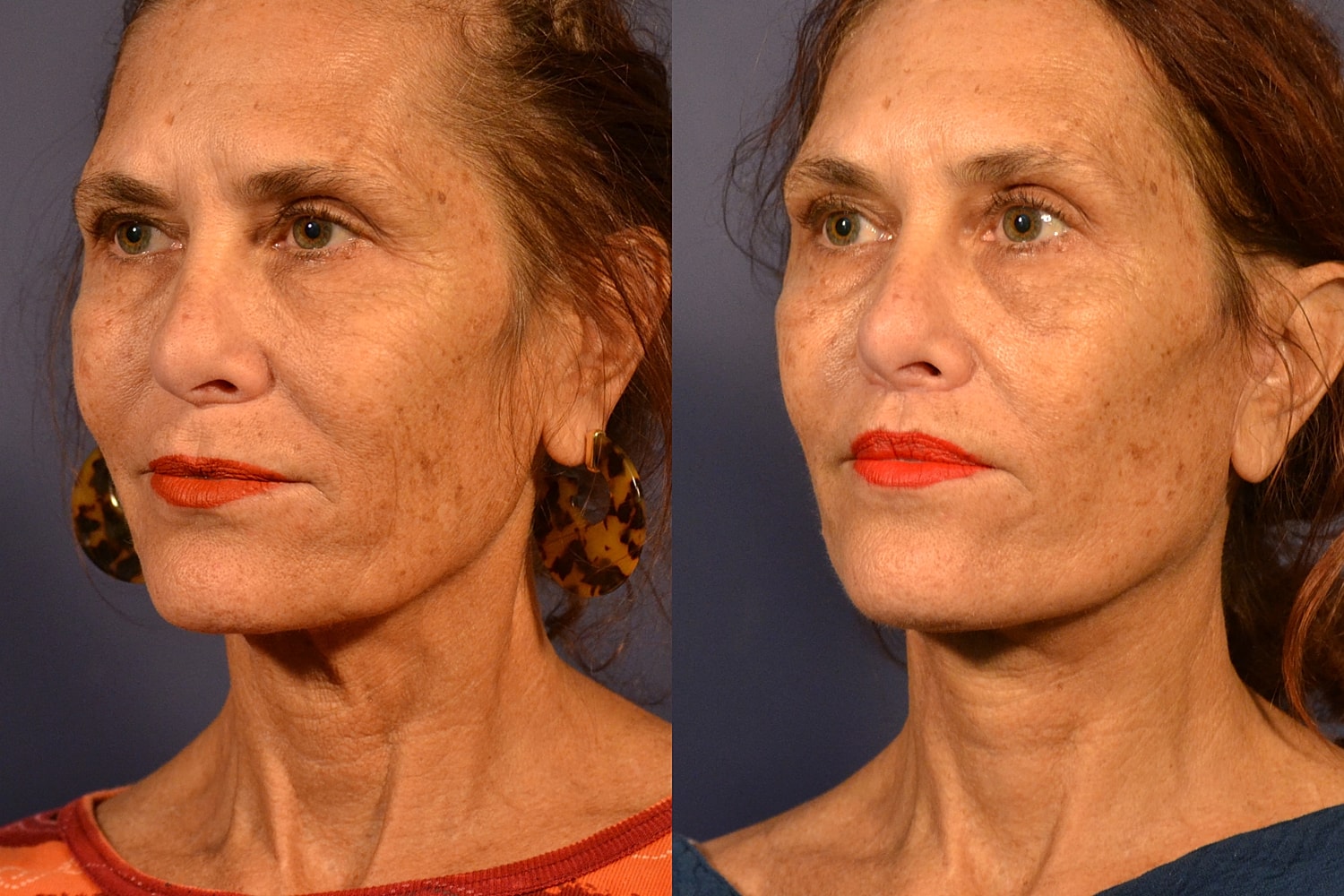 Facelift Before & After