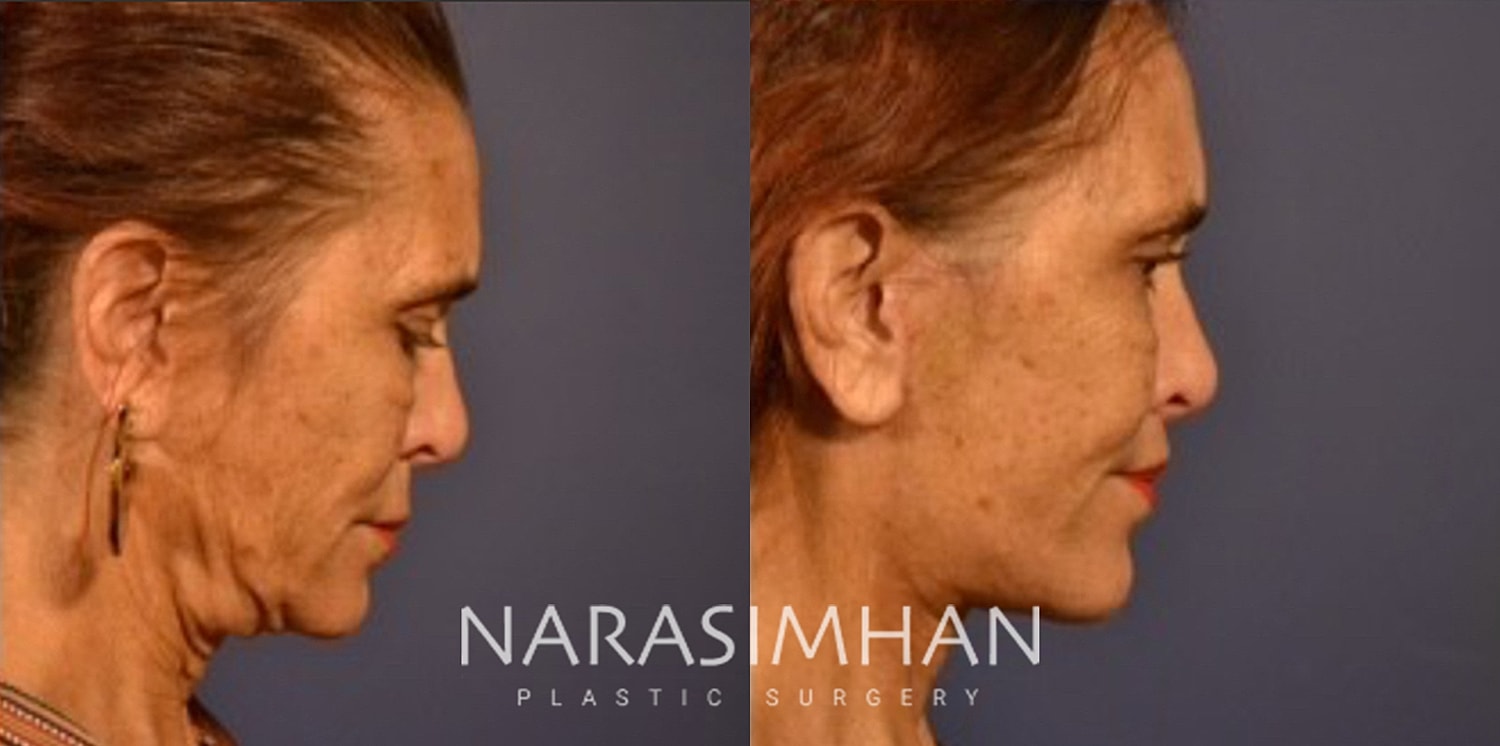 Facelift Before & After