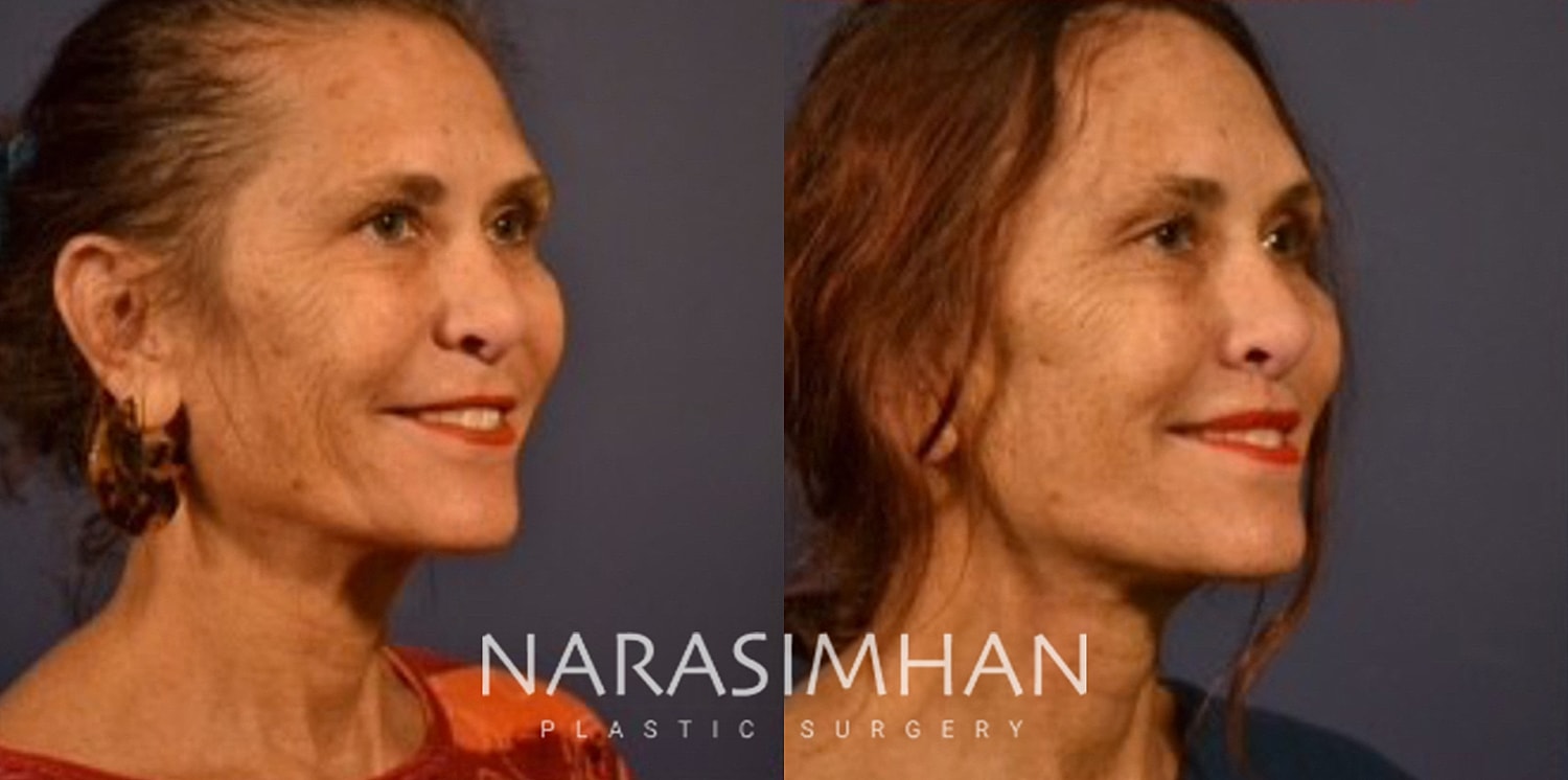 Facelift Before & After