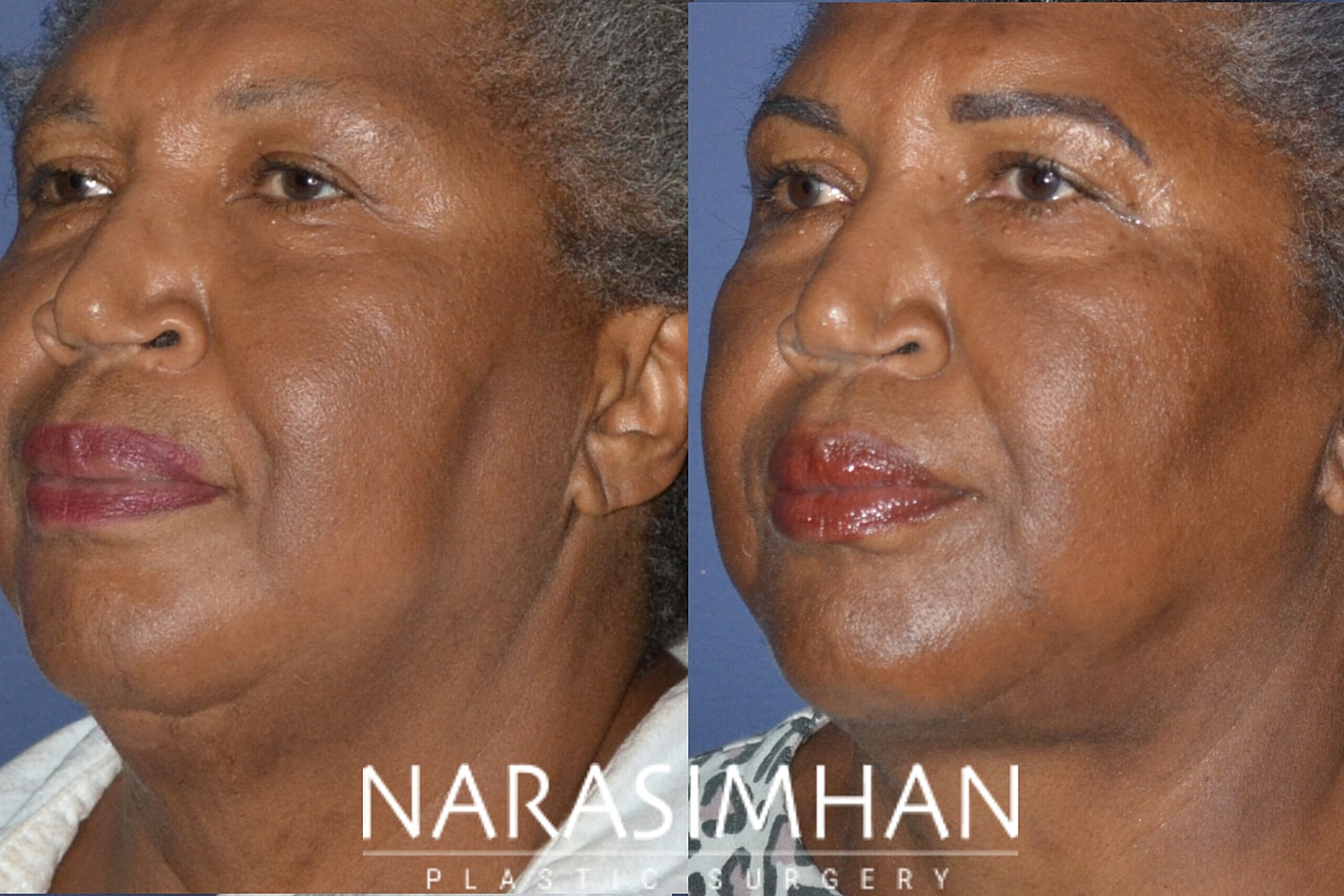 Facelift Before & After