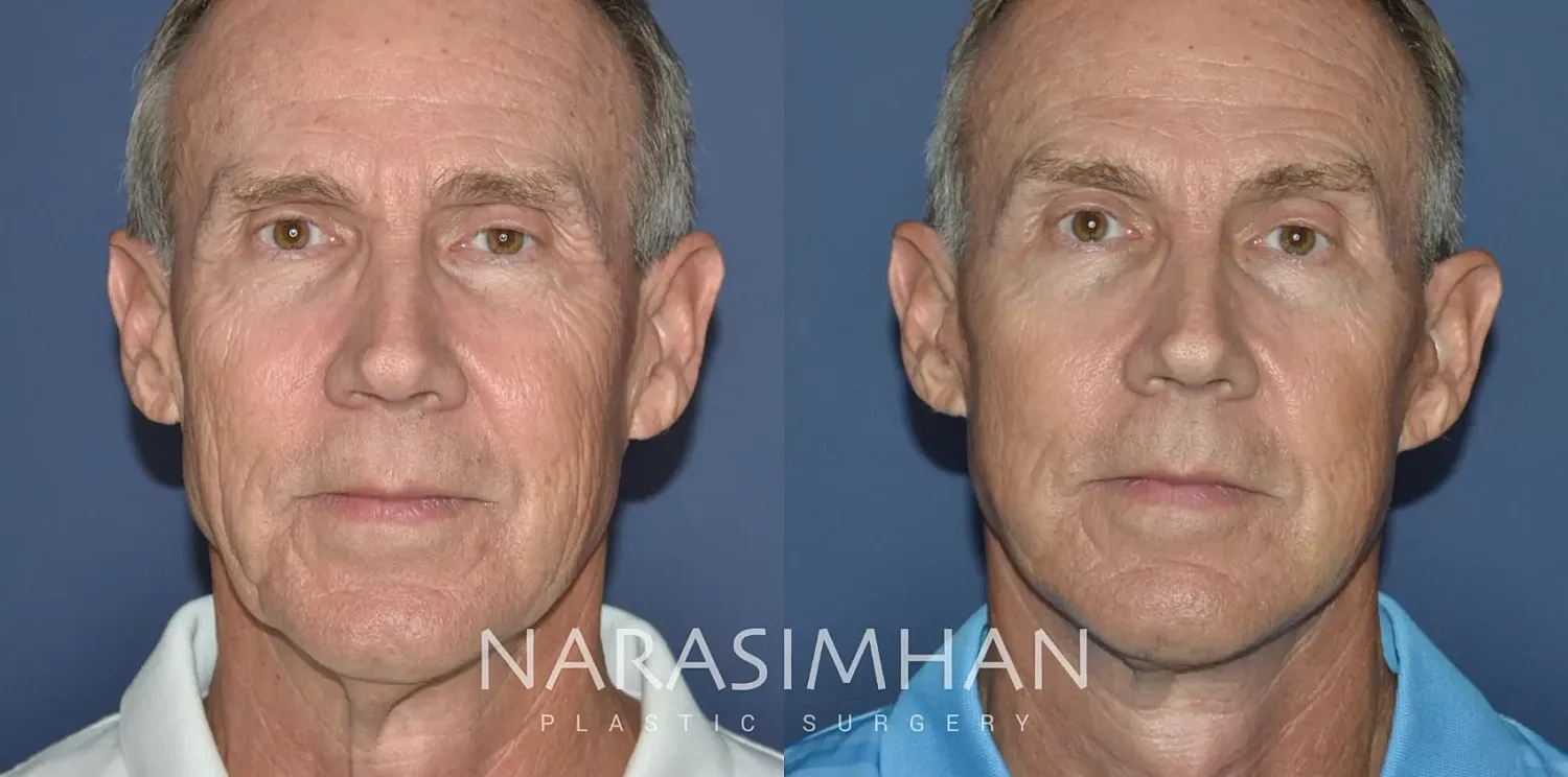 Facelift Before & After
