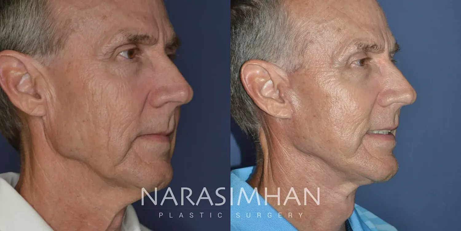 Facelift Before & After