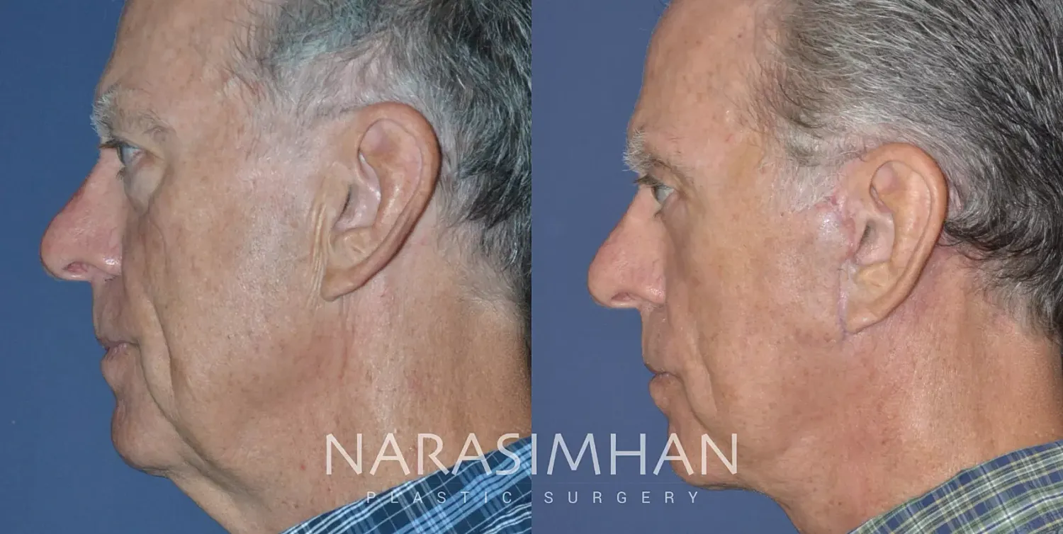 Facelift Before & After