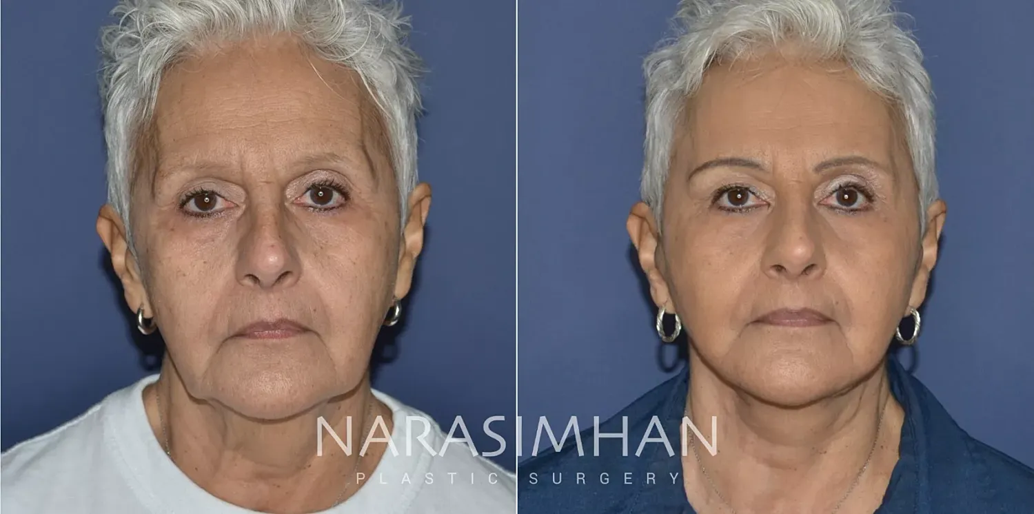 Facelift Before & After