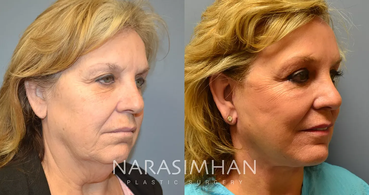 Facelift Before & After