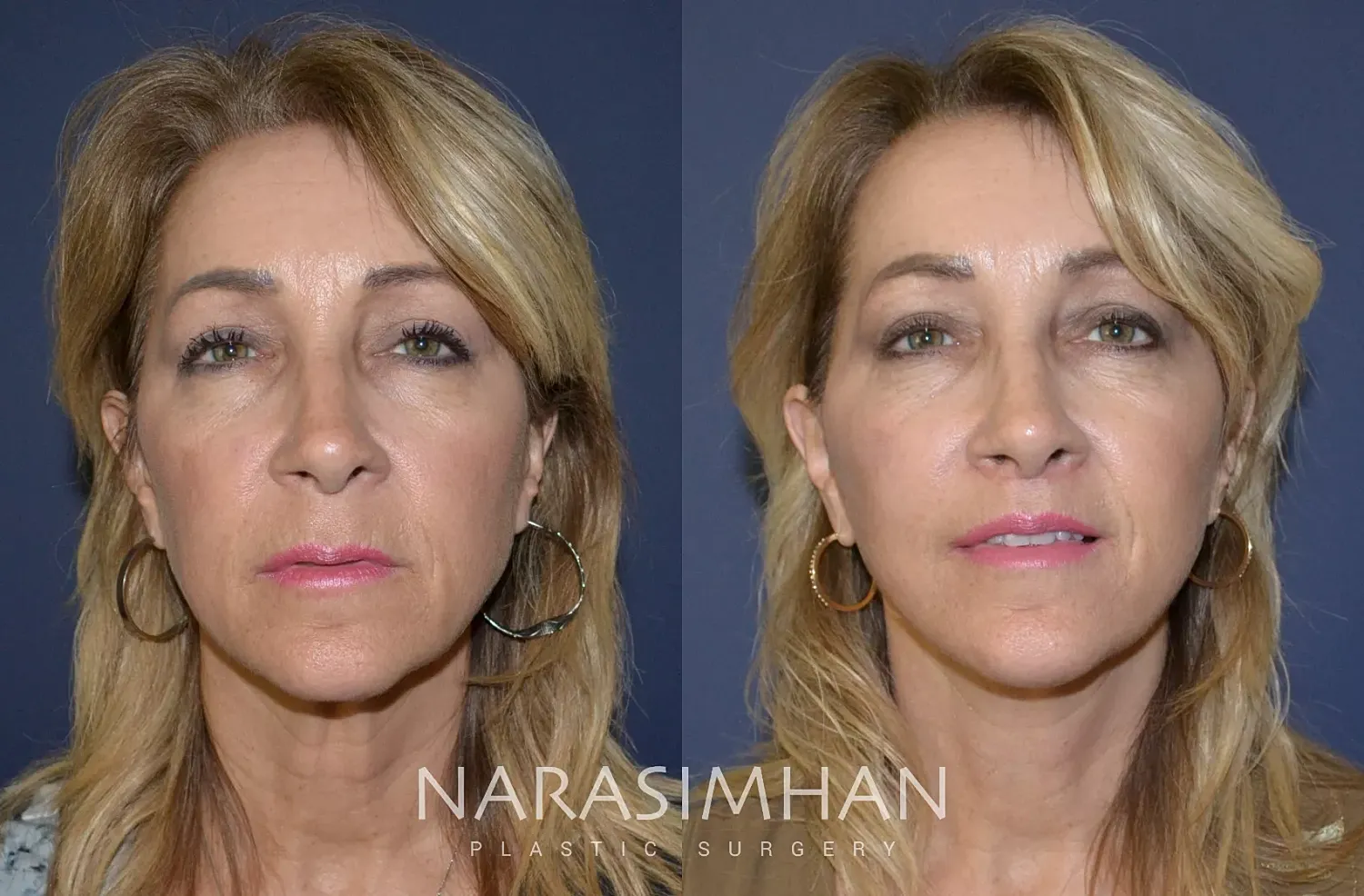 Facelift Before & After