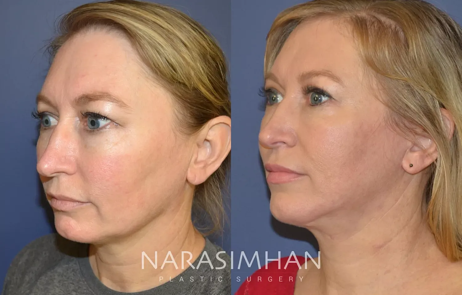 Facelift Before & After