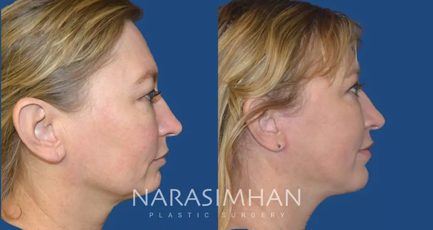 Facelift Before & After