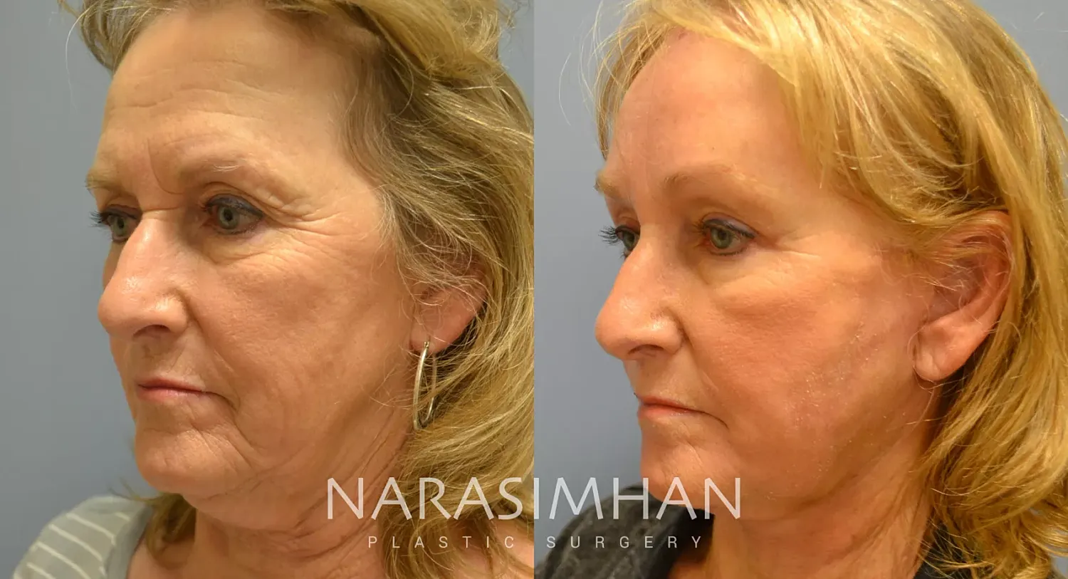 Facelift Before & After