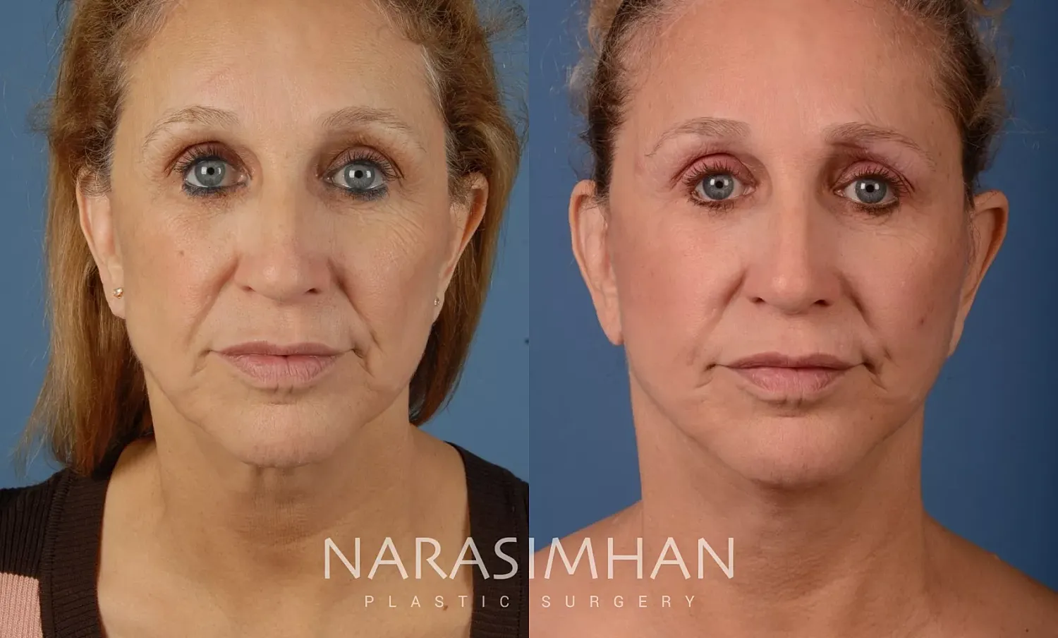Facelift Before & After