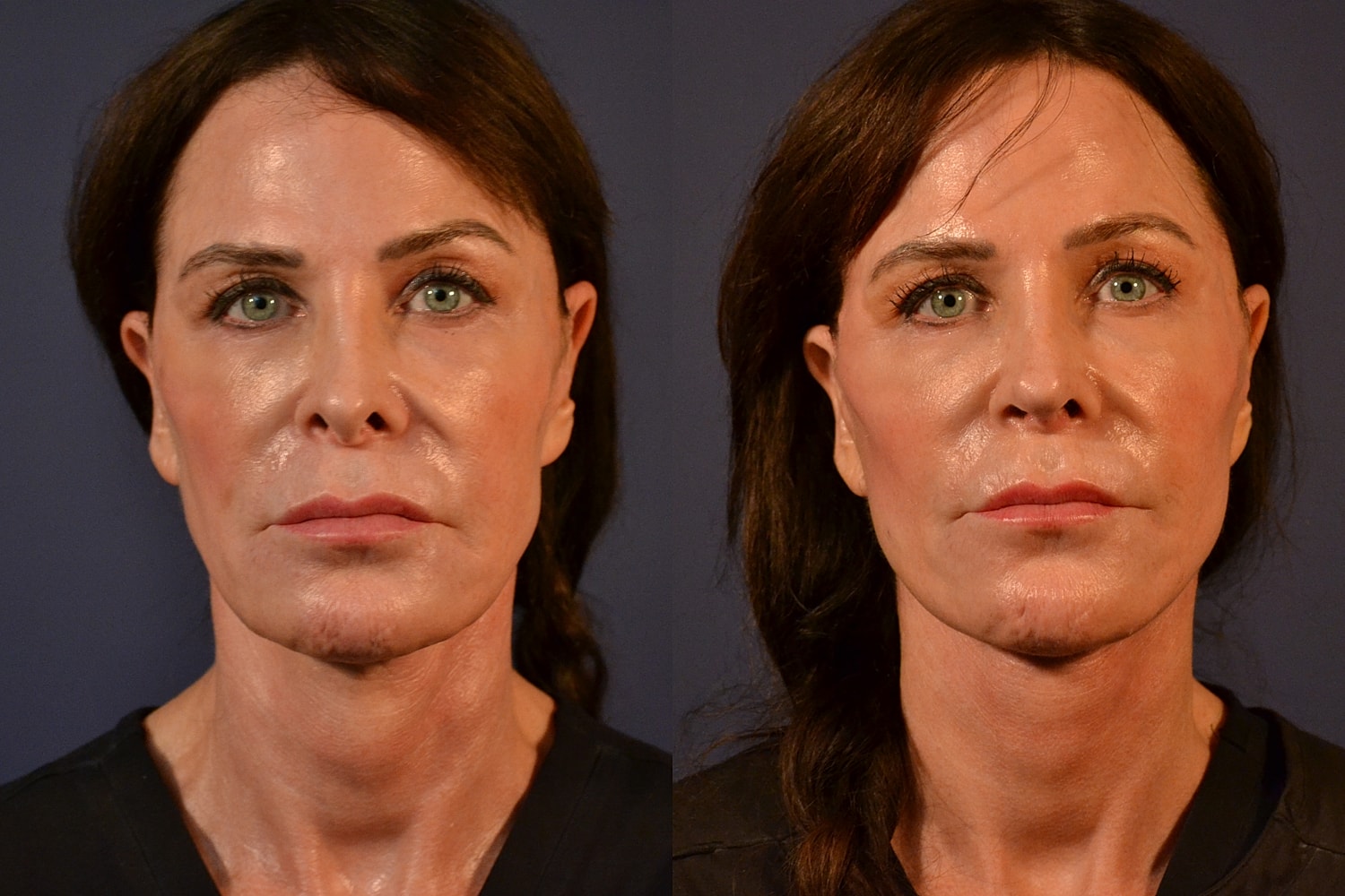 Facelift Before & After