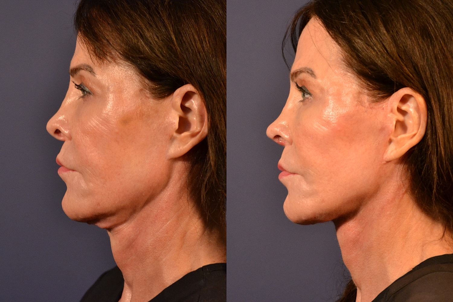 Facelift Before & After