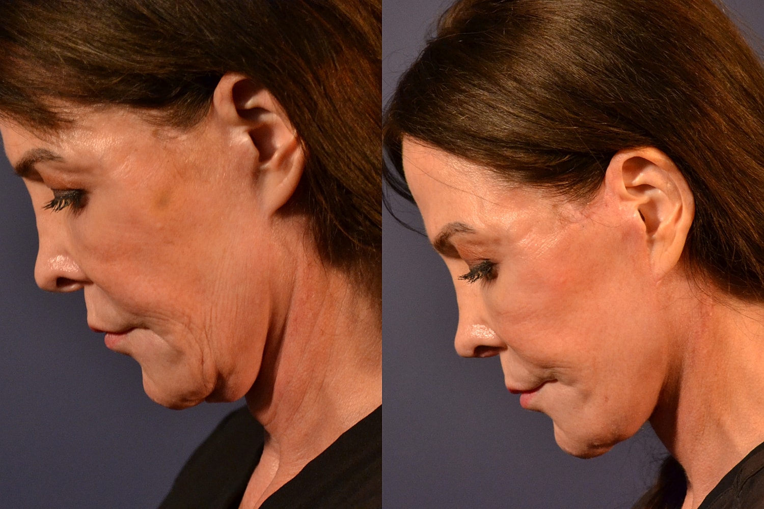 Facelift Before & After
