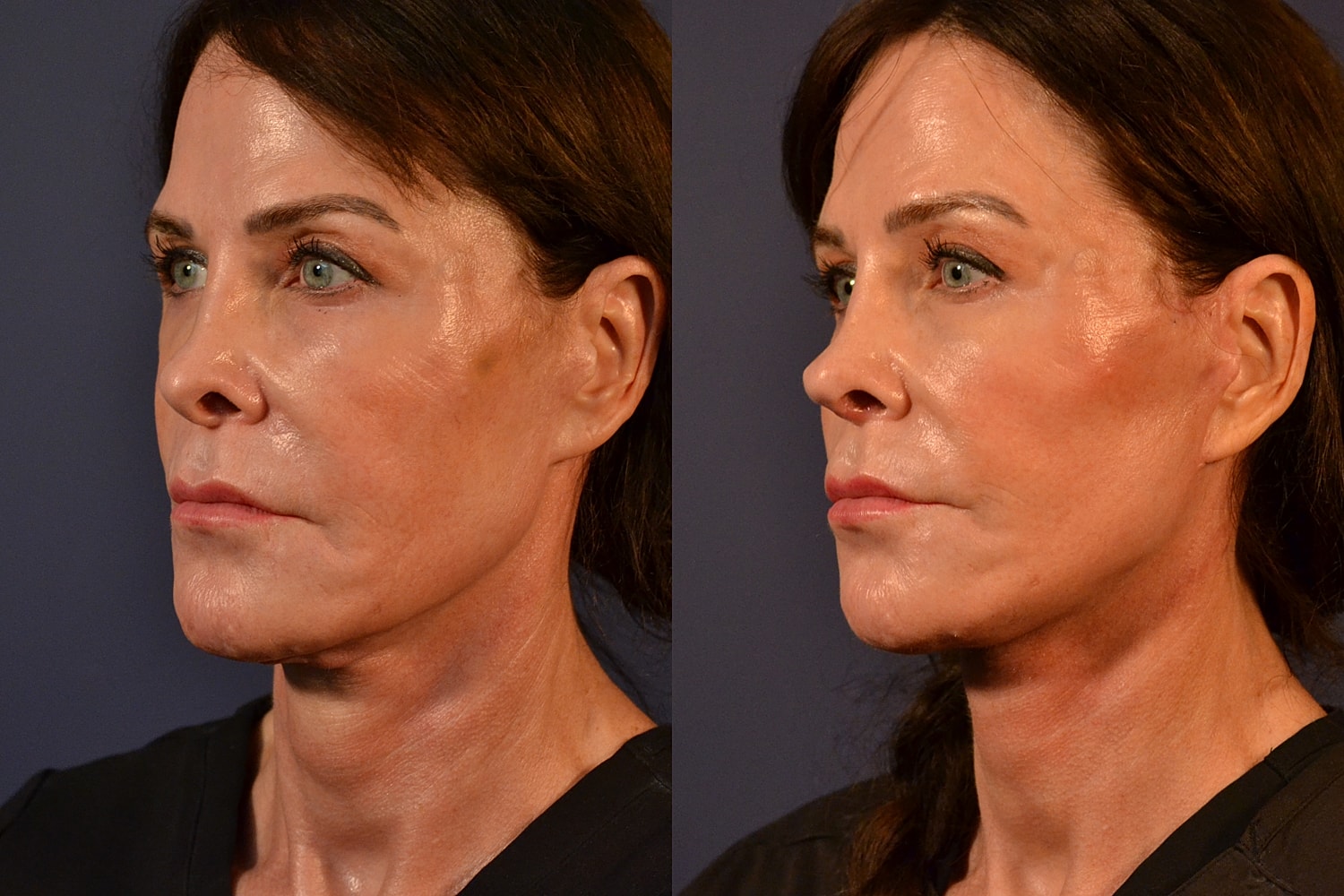 Facelift Before & After