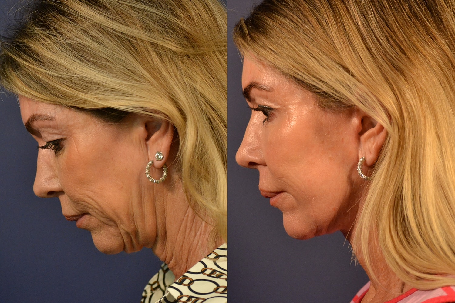 Before and after profile comparison on facial appearance.