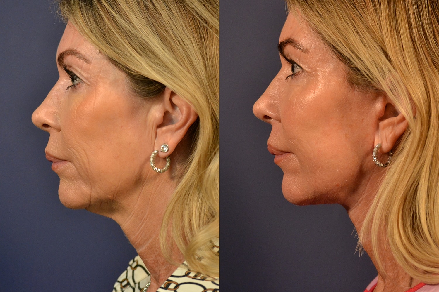 Profile comparison before and after treatment.