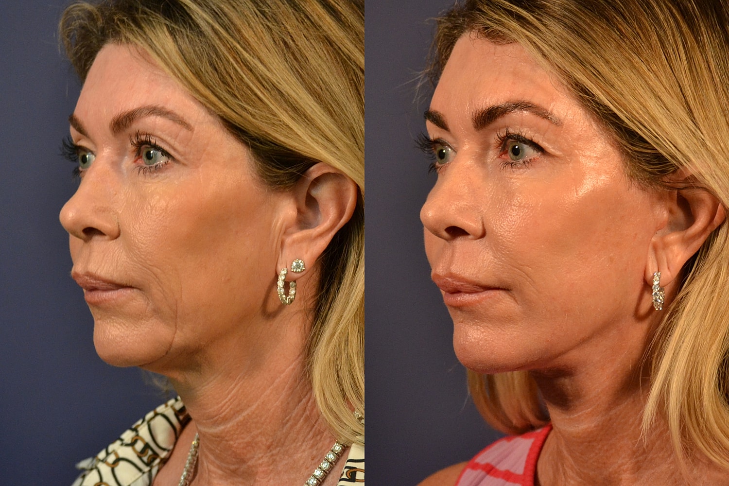 Before and after facial treatment comparison.