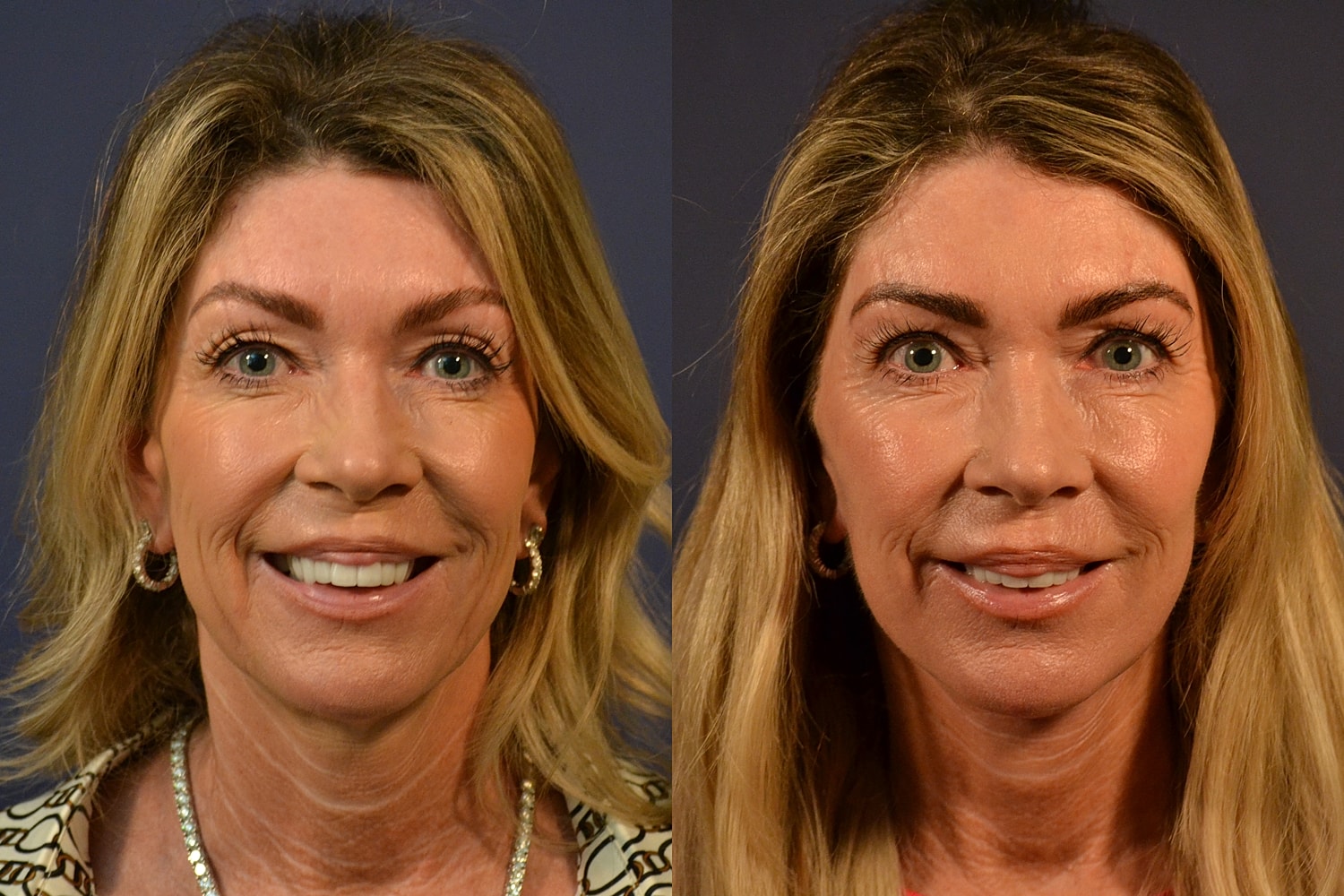 Before and after facial transformation side by side